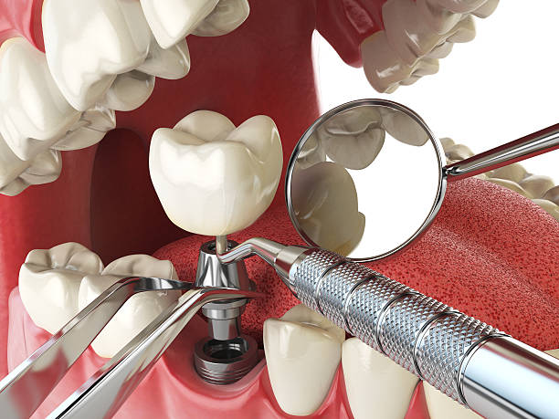 Best Knocked-Out Tooth Emergency  in Brighton, IL